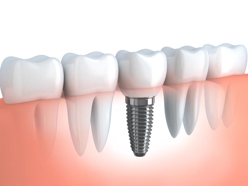 Dental Implants in Livingston and Kearny