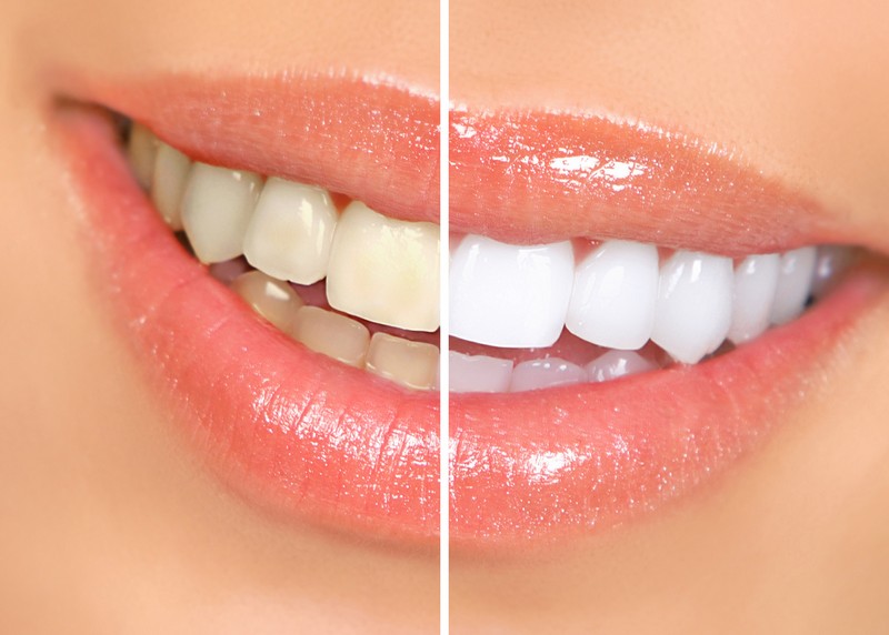 teeth whitening services in Livingston and Kearny