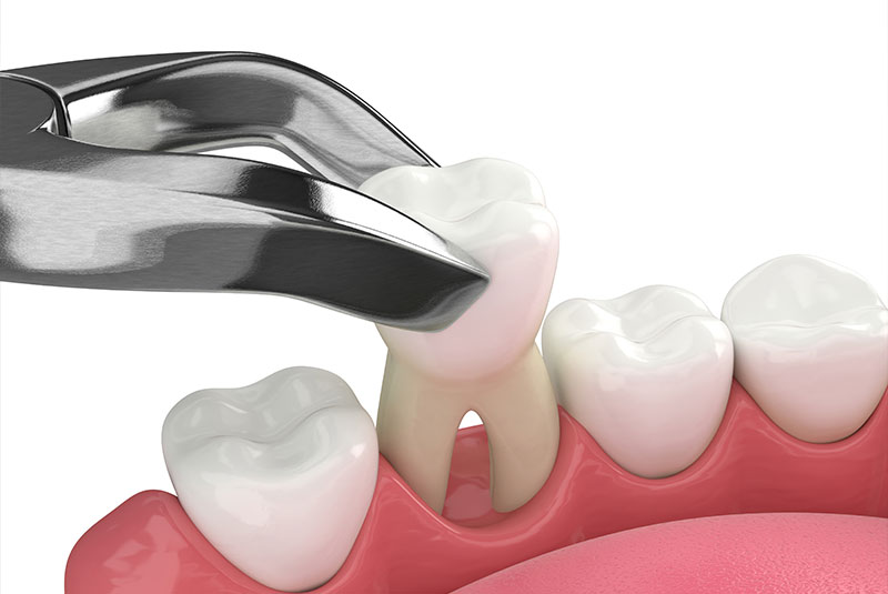 tooth extraction