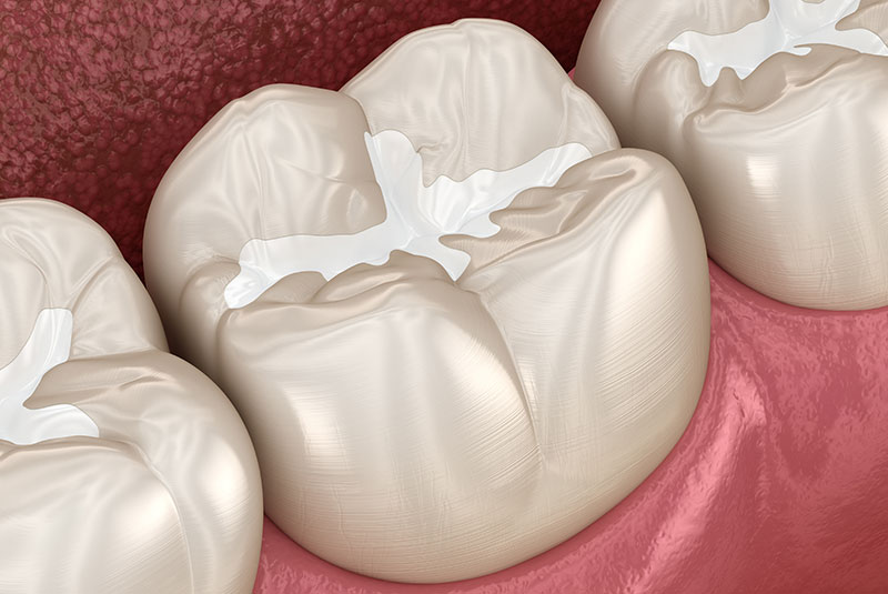 dental fillings