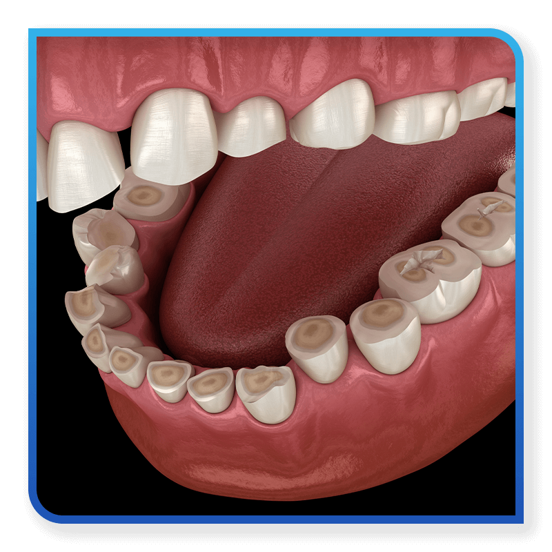 bruxism