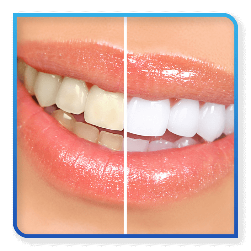 before after teeth whitening