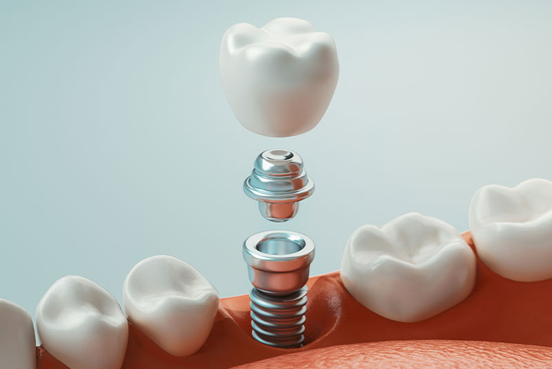 dental implants