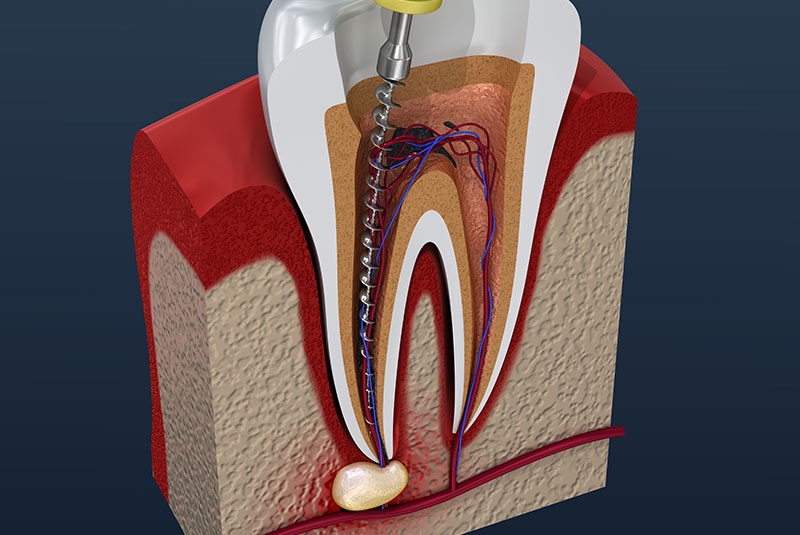 root canal
