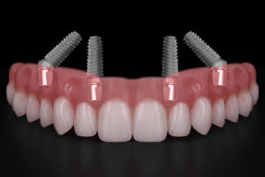 all on 4 dental implants with a full arch going across it